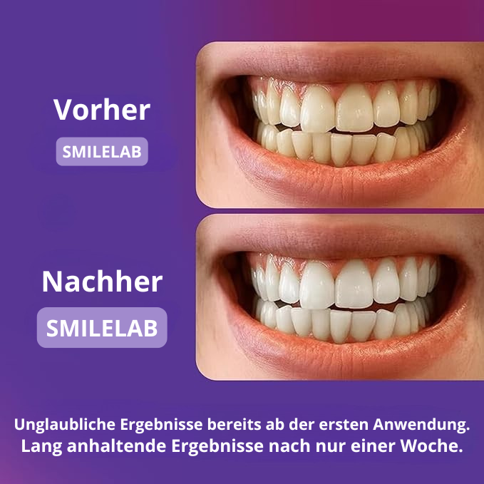 BLEACHING-STRIPS – PAP+ OHNE PEROXID - SmileLAB